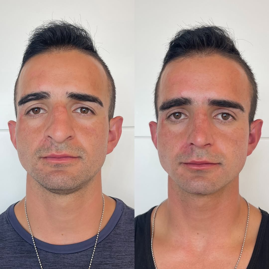Resultado de harmonização facial