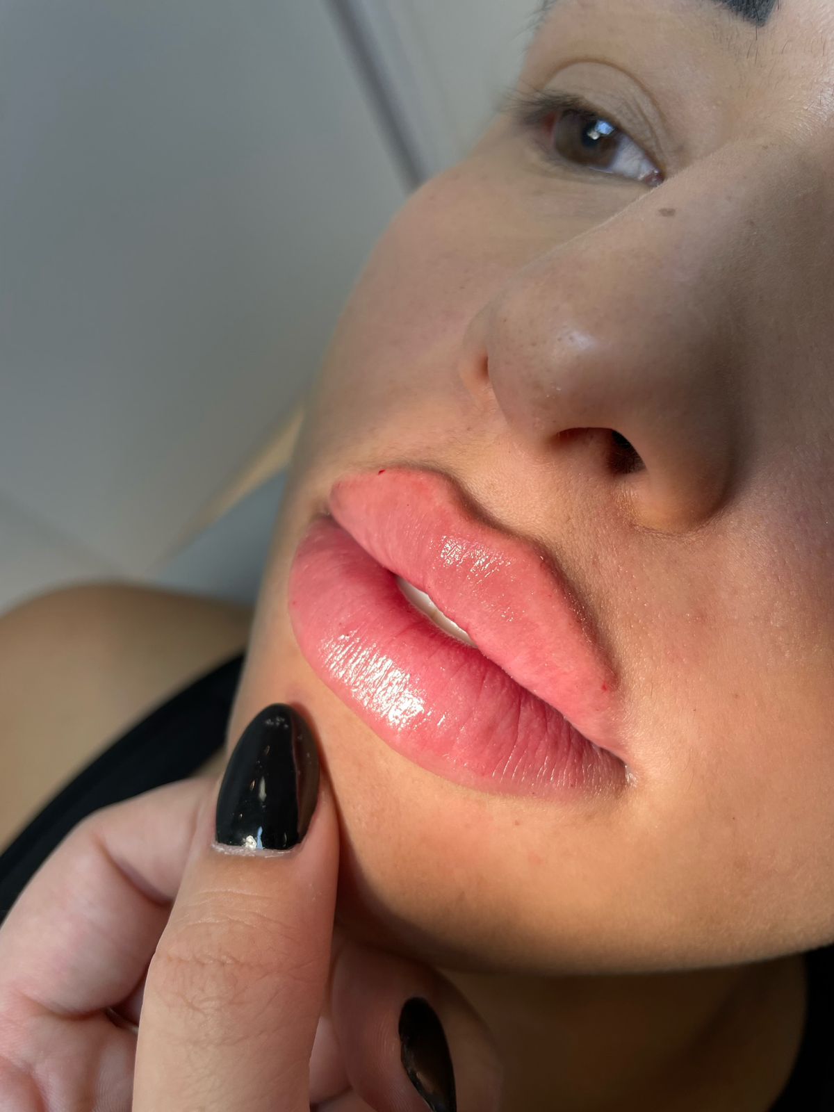 Resultado de preenchimento labial